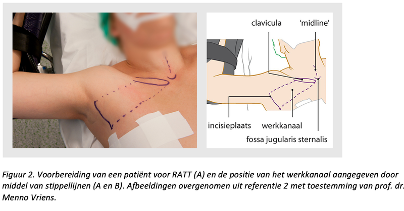 Afbeelding schildklierkanker chirurgie 02 onco#6 2021