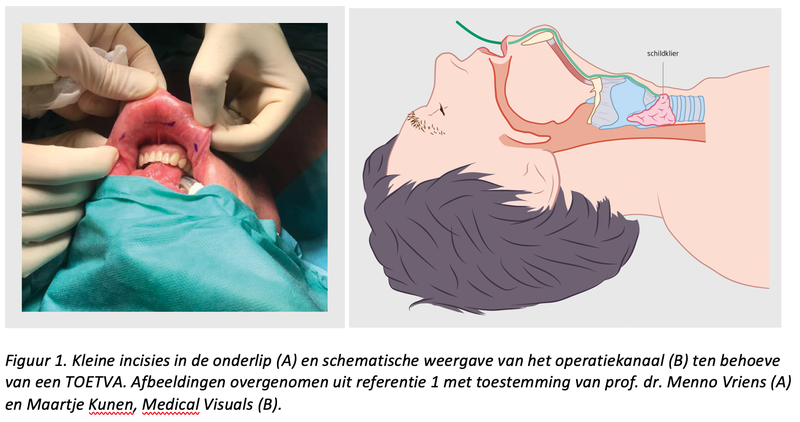 Afbeelding schildklierkanker chirurgie onco#6 2021