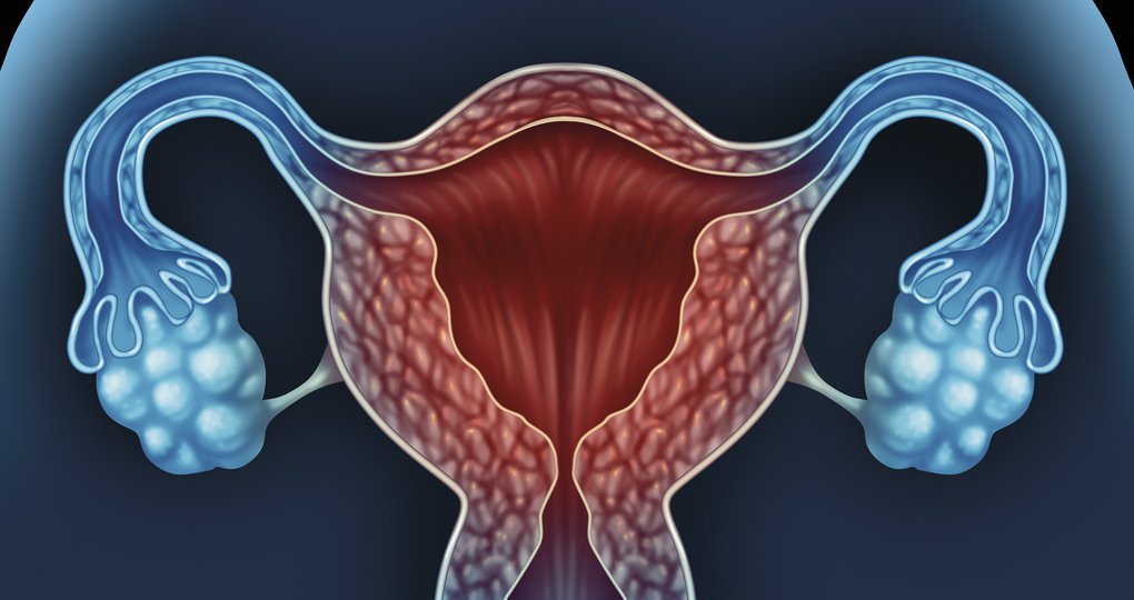 Ovarium carcinoom